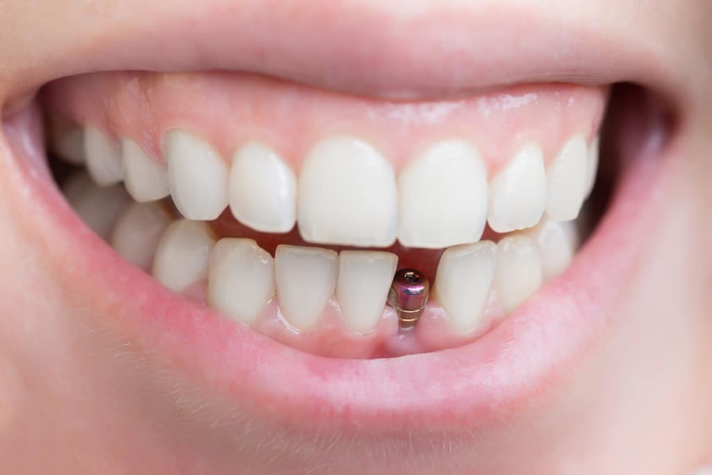 Dental Implants - Fioritto Family Dental