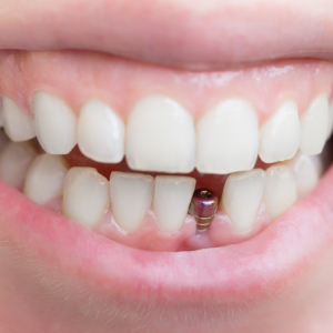 Dental Implants - Fioritto Family Dental