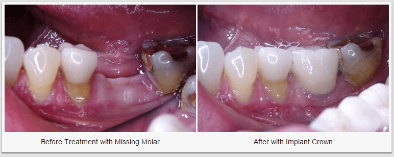 Dental crown molar