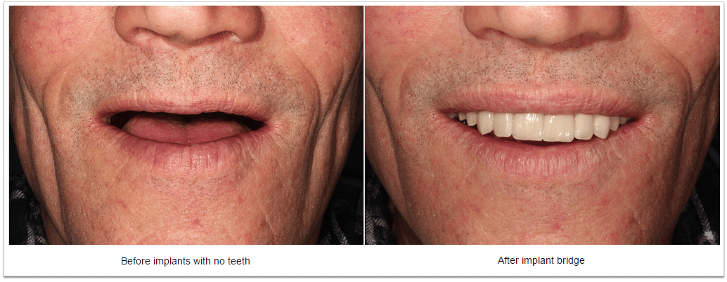 Implant bridge - Fioritto Family Dental