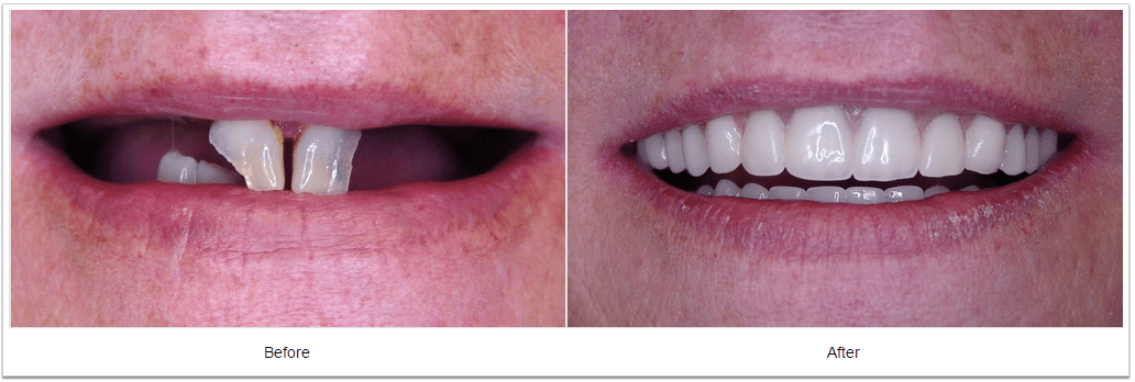 smile makeover Fioritto Family Dental