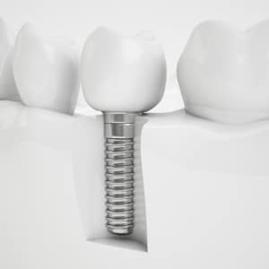 Dental implants
