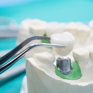 dentist implant