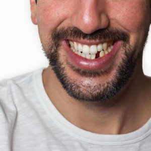 Missing tooth dentist
