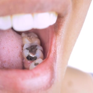 Fillings at dentist