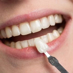 Teeth whitening