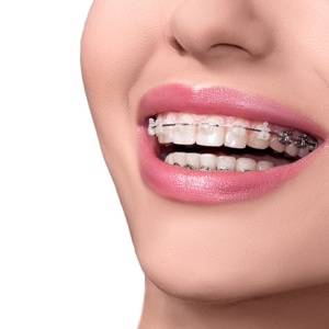 adult braces dentist