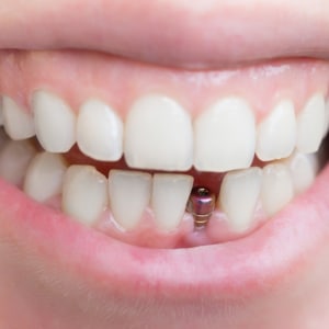 dental implant