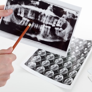 dental x rays