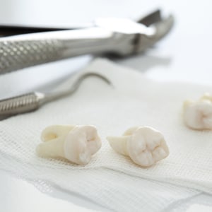 tooth extraction