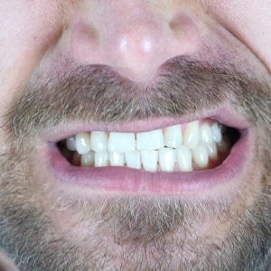 dental pain