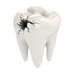 Endodontics Fioritto Family Dental