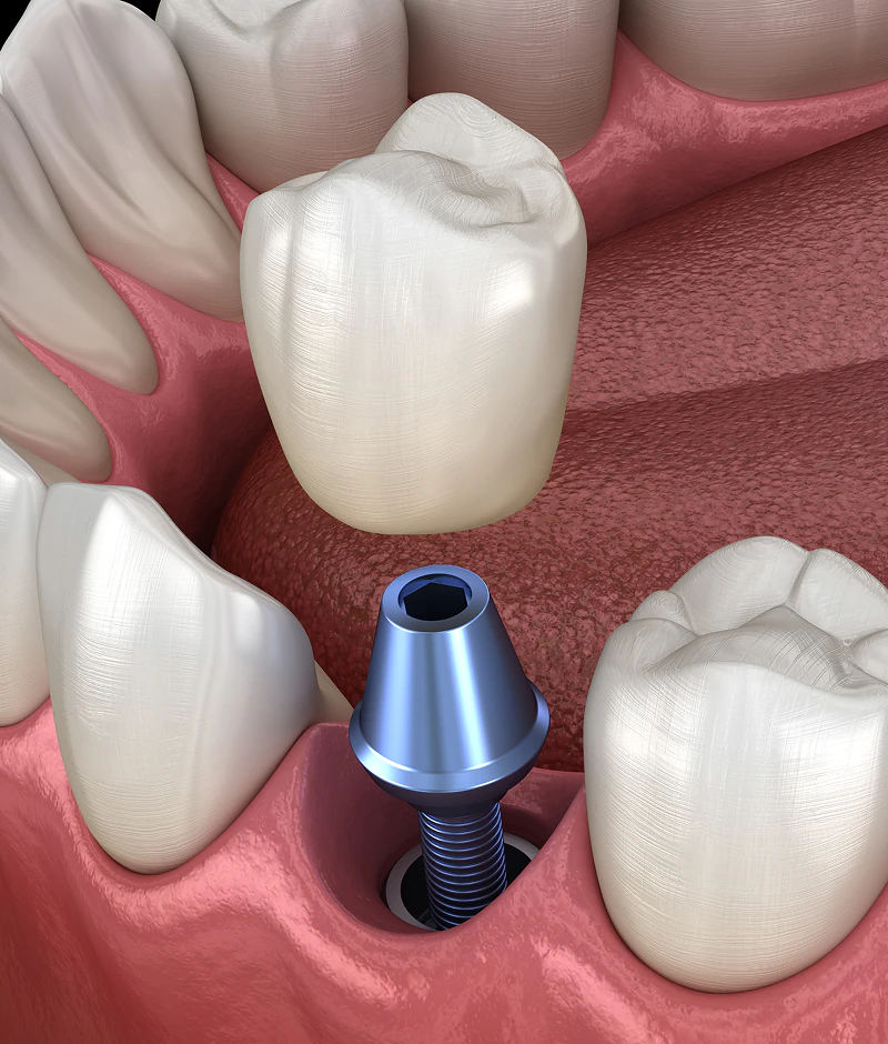 A 3D modal of the dental implant process as part of our Dental Implants options in Mentor & Concord, OH.