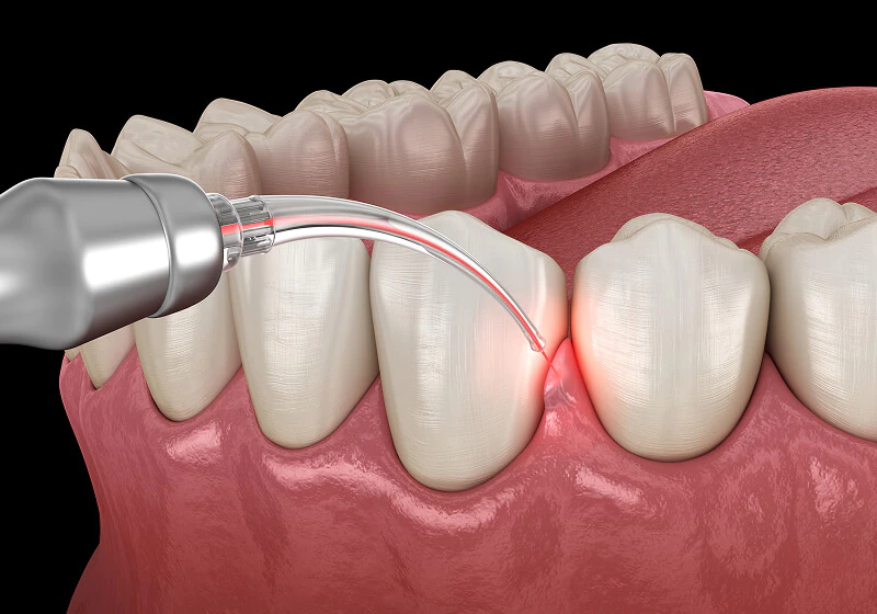 A 3D image of gums being treated on my a laser as part of the periodontal service options at Fioritto Family Dental in OH.