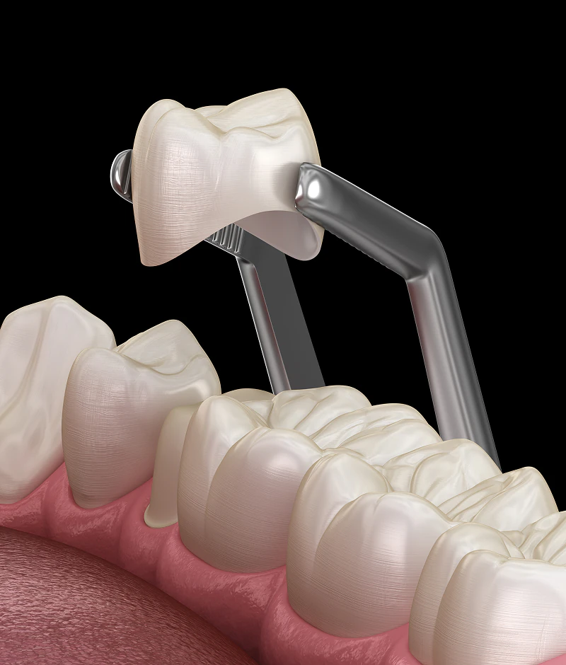 A 3D modal of dental crowns being placed on a tooth as part of Restorative Dentistry options in Mentor and Concord, OH at Fioritto Family Dental.