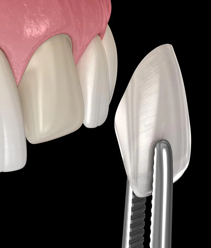 A 3D modal of a veneer being placed on a tooth as part of our cosmetic service options at Fioritto Family Dental in OH.